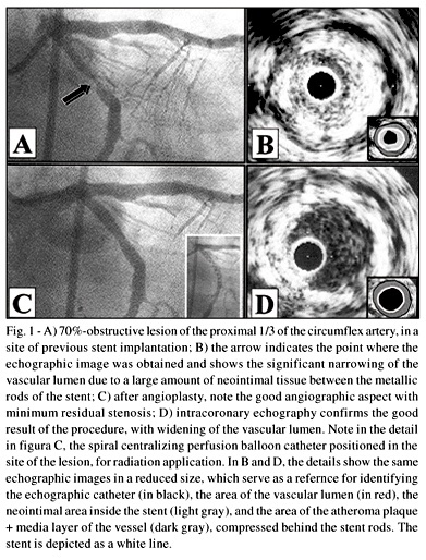 Intracoronary brachytherapy in the treatment of in-stent restenosis. Initial experience in Brazil