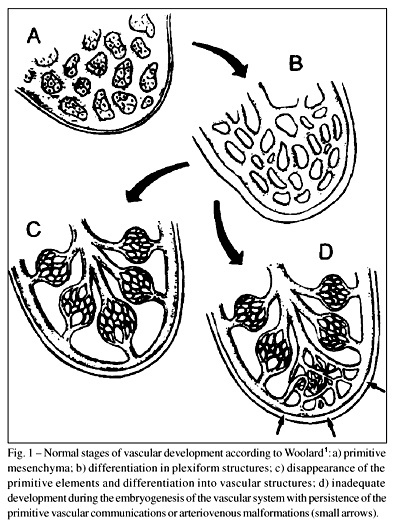 Diagnosis and therapeutics of pulmonary arteriovenous fistula in childhood. Case report and review of the literature