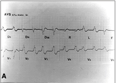 Corrected transposition of the great arteries with several associated anomalies in a 68-year-old patient