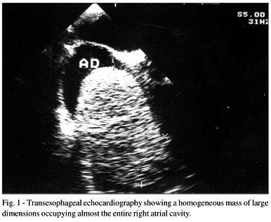 Lipoma of the right atrium