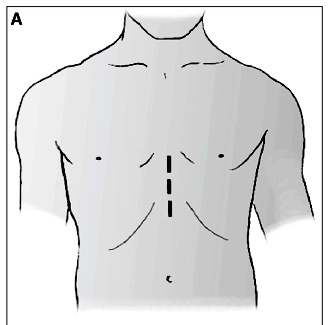 Video-assisted pericardioscopy. How to improve diagnostic efficacy in pericardial effusions
