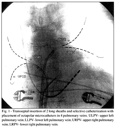 Treatment of atrial fibrillation with radiofrequency ablation and simultaneous multipolar mapping of the pulmonary veins