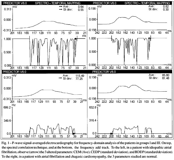Atrial activation during sinus rhythm in patients with rheumatic and non-rheumatic paroxysmal atrial fibrillation. Frequency-domain analysis using signal-averaged electrocardiography