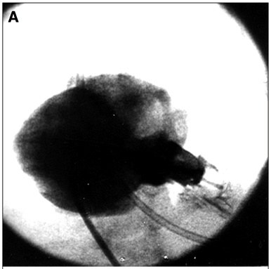 New percutaneous techniques for perforating the pulmonary valve in pulmonary atresia with intact ventricular septum