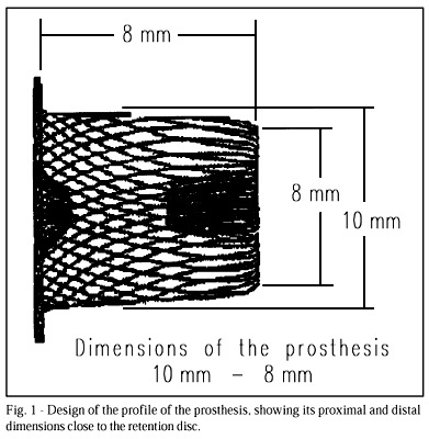 Percutaneous closure of ductus arteriosus with the amplatzer prosthesis. The Brazilian experience