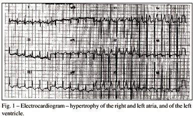 Case 6/2001 - The patient is an 11-year-old girl with Takayasu's arteritis and heart failure (Instituto do Coração do Hospital das Clínicas - FMUSP - São Paulo)