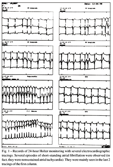 Useful clinical features for the selection of ideal patients with strial fibrillation for mapping and catheter ablation