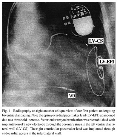 Ventricular resynchronization through biventricular cardiac pacing for the treatment of refractory heart failure in dilated cardiomyopathy