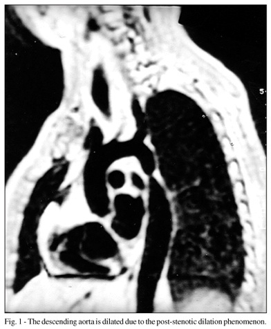 Cardiovascular assessment of patients with Ullrich-Turner's Syndrome on Doppler echocardiography and magnetic resonance imaging
