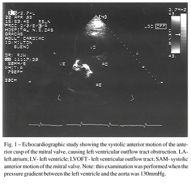 Obstruction of the left ventricular outflow tract after mitral valvuloplasty with implantation of Gregori's ring
