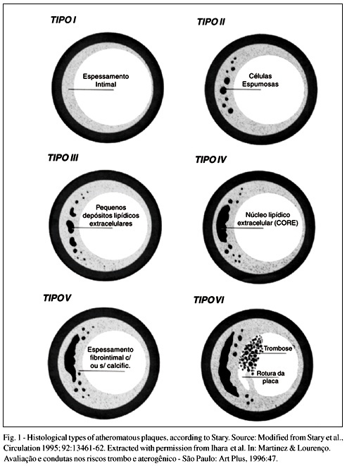 Anatomicopathological evidence of the beginning of atherosclerosis in infancy and adolescence