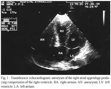 Aneurysm of the Right Atrial Appendage