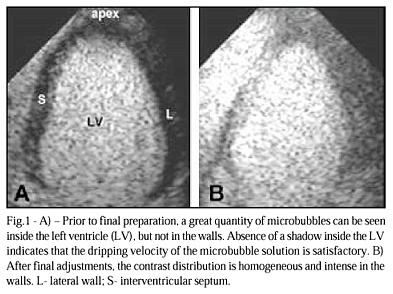 Study of Coronary Flow Reserve with Intravenous Use of Microbubbles (Contrast Echocardiography) and Adenosine: Protocol for Clinical Application in Patients Suspected of Having Coronary Heart Disease