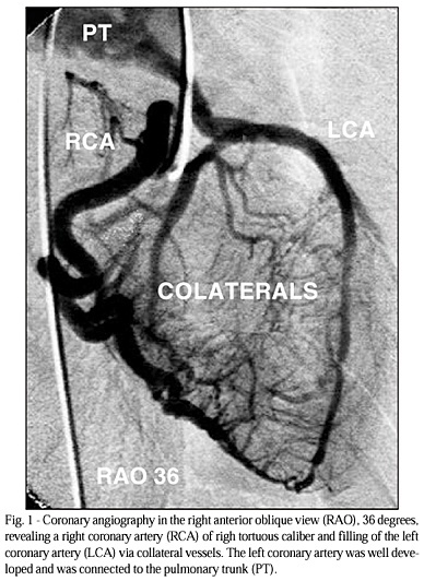 Anomalous Origin of the Left Coronary Artery from the Pulmonary Artery: Report of an Adult Case