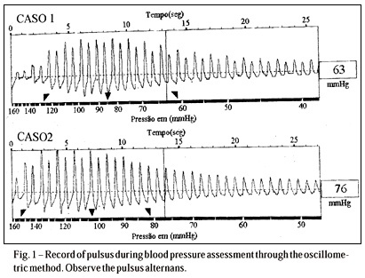 Nonrespiratory Sinus Arrhythmia