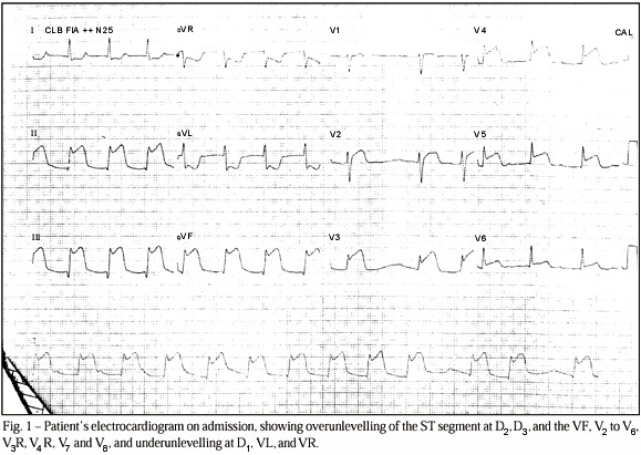 Concomitant Use of Glycoprotein IIb/IIIa Inhibitor and Streptokinase after Unsuccessful Rescue Angioplasty