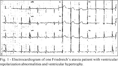 Friedreich's Ataxia: Cardiac Evaluation of 25 Patients with Clinical Diagnosis and Literature Review