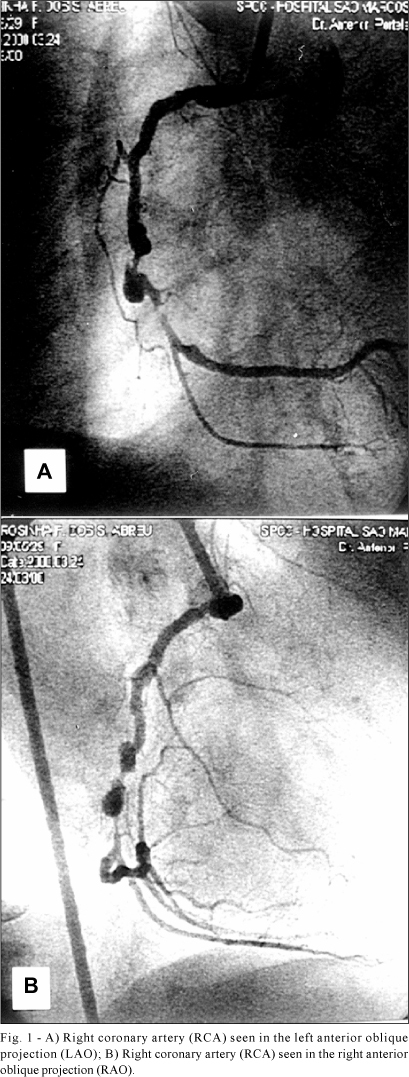 Repair of an Atherosclerotic Coronary Artery Aneurysm by Implantation of a Coronary Covered Stent