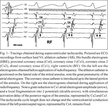 Block of the Mitral-pulmonary Isthmus During Ablation of a Single Left-sided Accessory Pathway Causing Different Patterns of Retrograde Atrial Activation