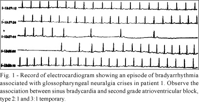 Glossopharyngeal Neuralgia Associated with Cardiac Syncope