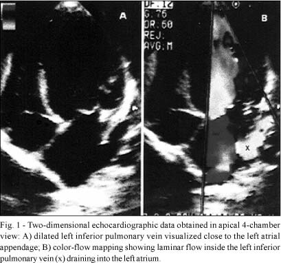 Echocardiographic Assessment of the Pulmonary Venous Flow: An Indicator of Increased Pulmonary Flow in Congenital Cardiac Malformations