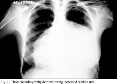 Pericardial Effusion with Cardiac Tamponade as a Form of Presentation of Primary Hypothyroidism