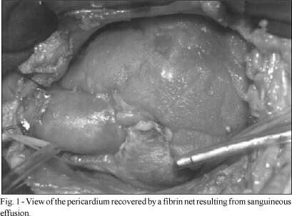 Primary Cardiac Angiosarcoma: A Therapeutical Dilemma