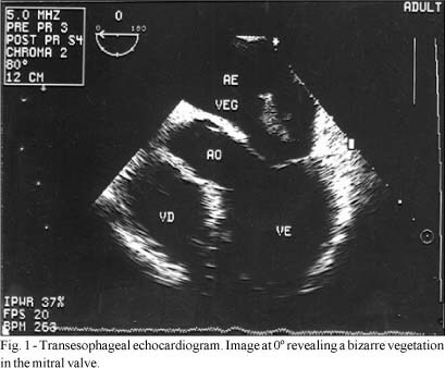 Multiple Embolism in a Female Patient with Infective Endocarditis: Low Back Pain and Hematuria as the Initial Clinical Manifestations