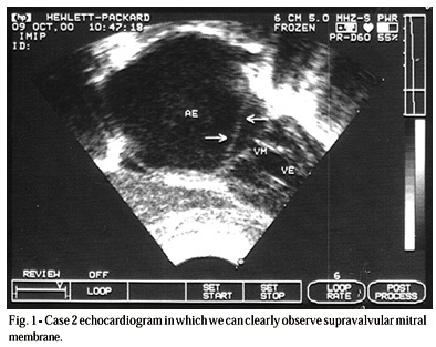 Supravalvular Congenital Mitral Stenosis