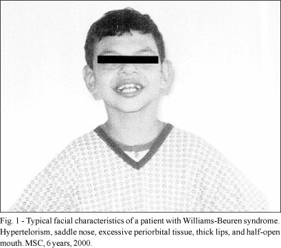 Arterial Hypertension in a Child with Williams-Beuren Syndrome (7q11.23 Chromosomal Deletion)