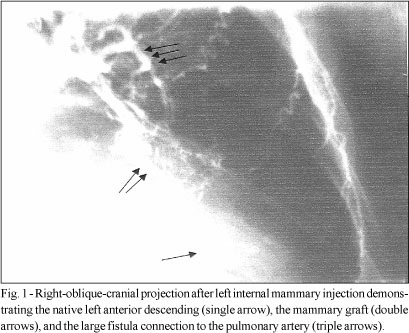 Internal Mammary to Pulmonary Artery Fistula Presenting as Early Recurrent Angina after Coronary Bypass