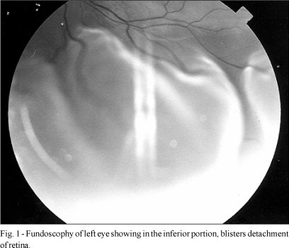 Retinal Detachment in Preeclampsia