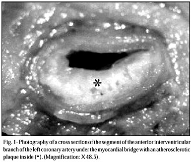 Myocardial Bridges and their Relationship to the Anterior Interventricular Branch of the Left Coronary Artery