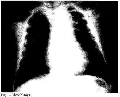 Silent Patent Ductus Arteriosus Aneurysm