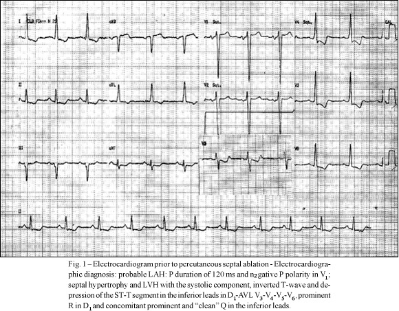 Vector electrocardiographic alterations after percutaneous septal ablation in obstructive hypertrophic cardiomyopathy: possible anatomic causes