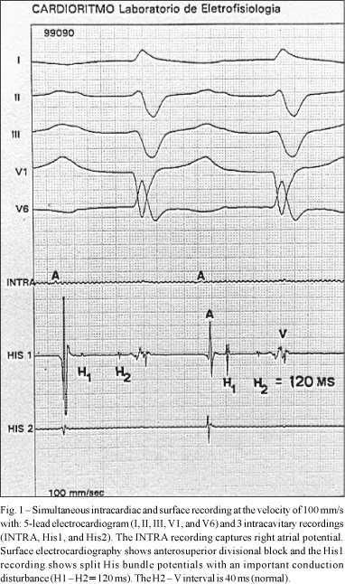 Intra-His bundle block: clinical, electrocardiographic, and electrophysiologic characteristics