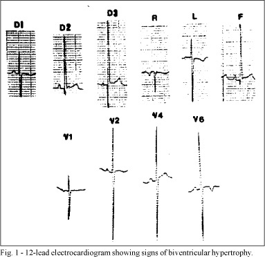 Anomalous origin of the left pulmonary artery from the ascending aorta: successful surgical correction in an infant with fallot's tetralogy