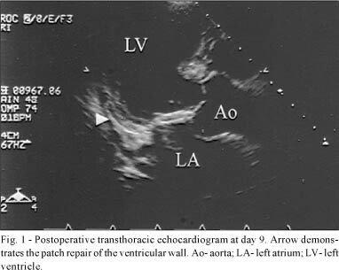 Treatment of delayed rupture of the left ventricle after mitral valve replacement