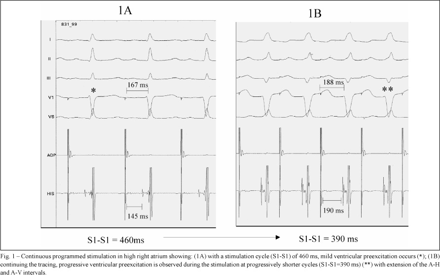 Catheter ablation of atriofascicular Mahaim fibers guided by the activation potential