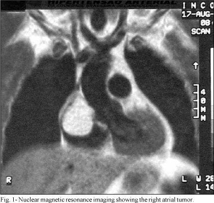 Right atrial lipoma