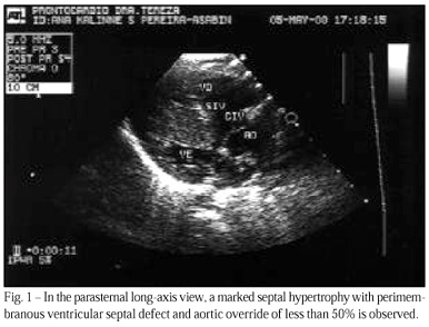 Tetralogy of Fallot and hypertrophic cardiomyopathy: a rare association