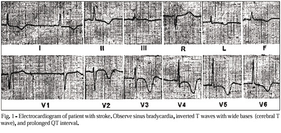 Electrocardiographic abnormalities in neurological diseases