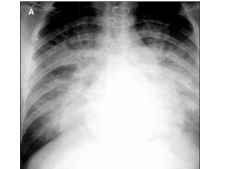 Infective endocarditis: surgical therapy