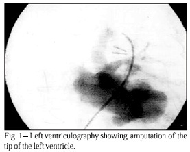 Endomyocardial fibrosis in infancy