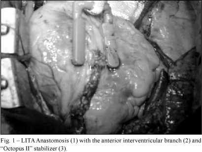 Surgical myocardial revascularization without extracorporeal circulation