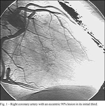 Dual anterior descending coronary artery associated with coronary artery disease