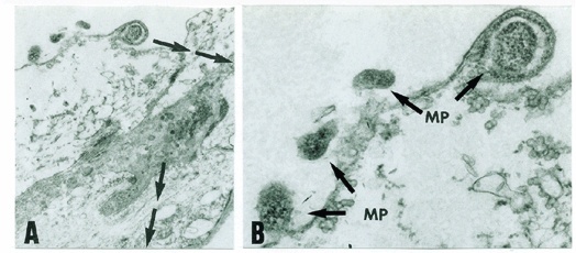 Coinfection with Mycoplasma Pneumoniae and Chlamydia Pneumoniae in ruptured plaques associated with acute myocardial infarction