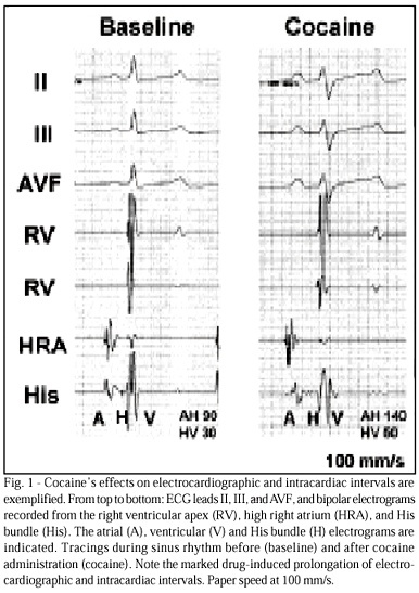 Characterization of the in vivo cardiac electrophysiologic effects of high-dose cocaine in closed-chest, anesthetized dogs with normal hearts