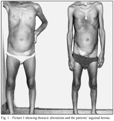 Marfan's syndrome: early and severe form in siblings