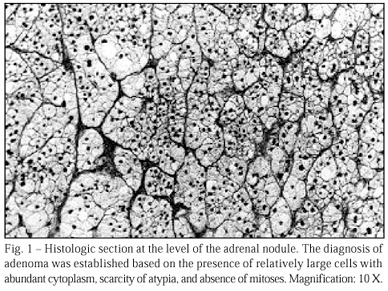 Malignant hypertension and hypertensive encephalopathy in primary aldosteronism caused by adrenal adenoma